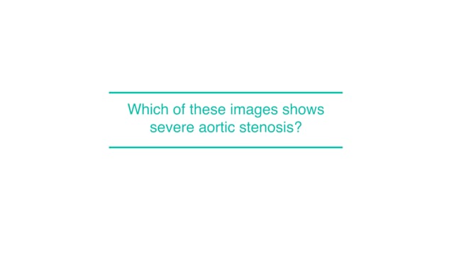 Which of these images shows a severe aortic stenosis?