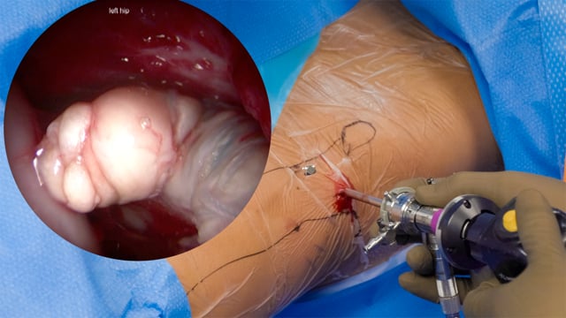 Arthroscopic Repair of a Fascia Lata Labral Reconstruction Allograft Limb Detachment