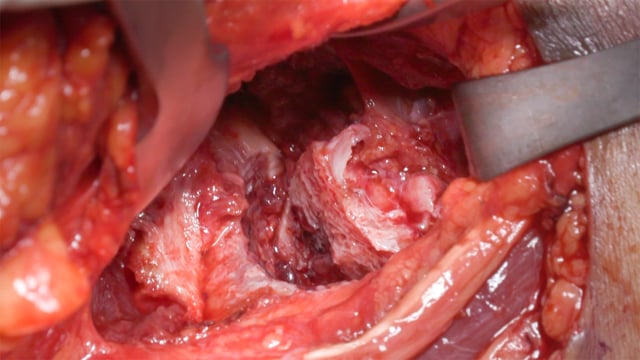 Displaced Posterior Cruciate Avulsion Fracture Fixation with Medial Collateral Ligament Repair Using Combined Open and Arthroscopic Methods