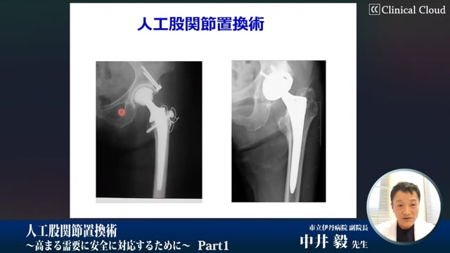 人工股関節置換術〜高まる需要に安全に対応するために〜 Part1