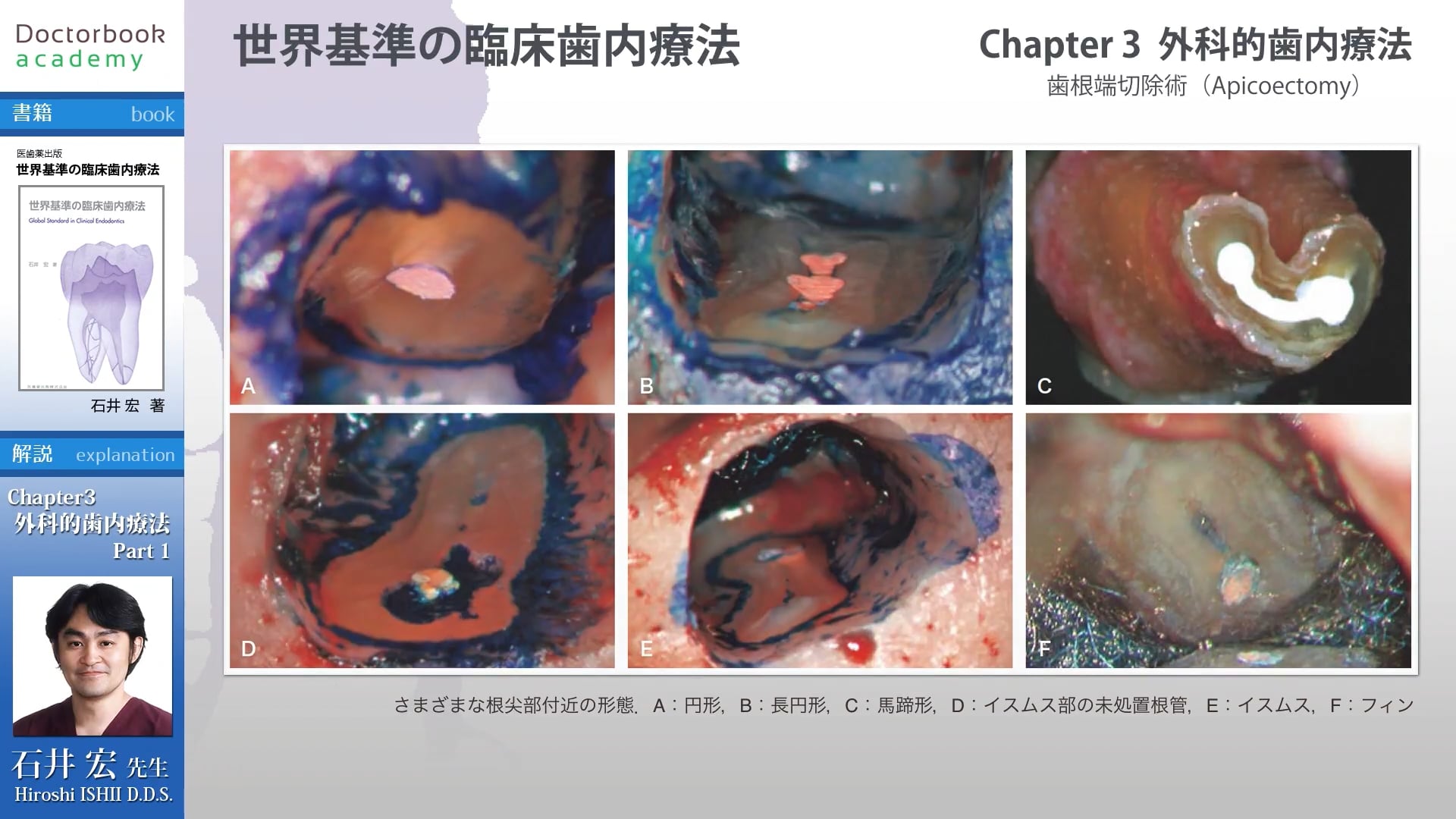 臨床知見録_歯根端切除_外科的歯内療法の適応症と非適応症の比較