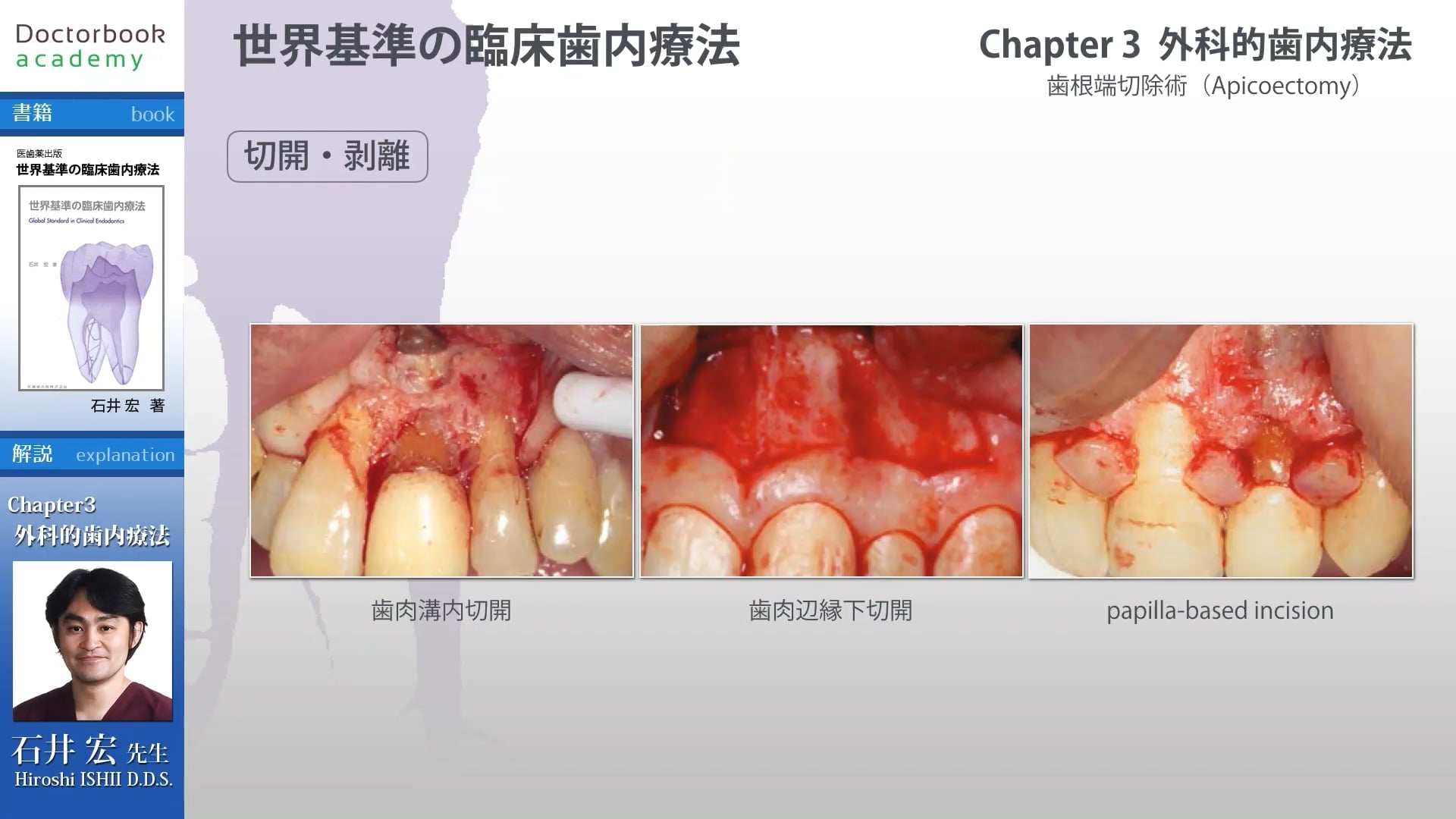 臨床知見録_歯根端切除_歯肉辺縁下切開について