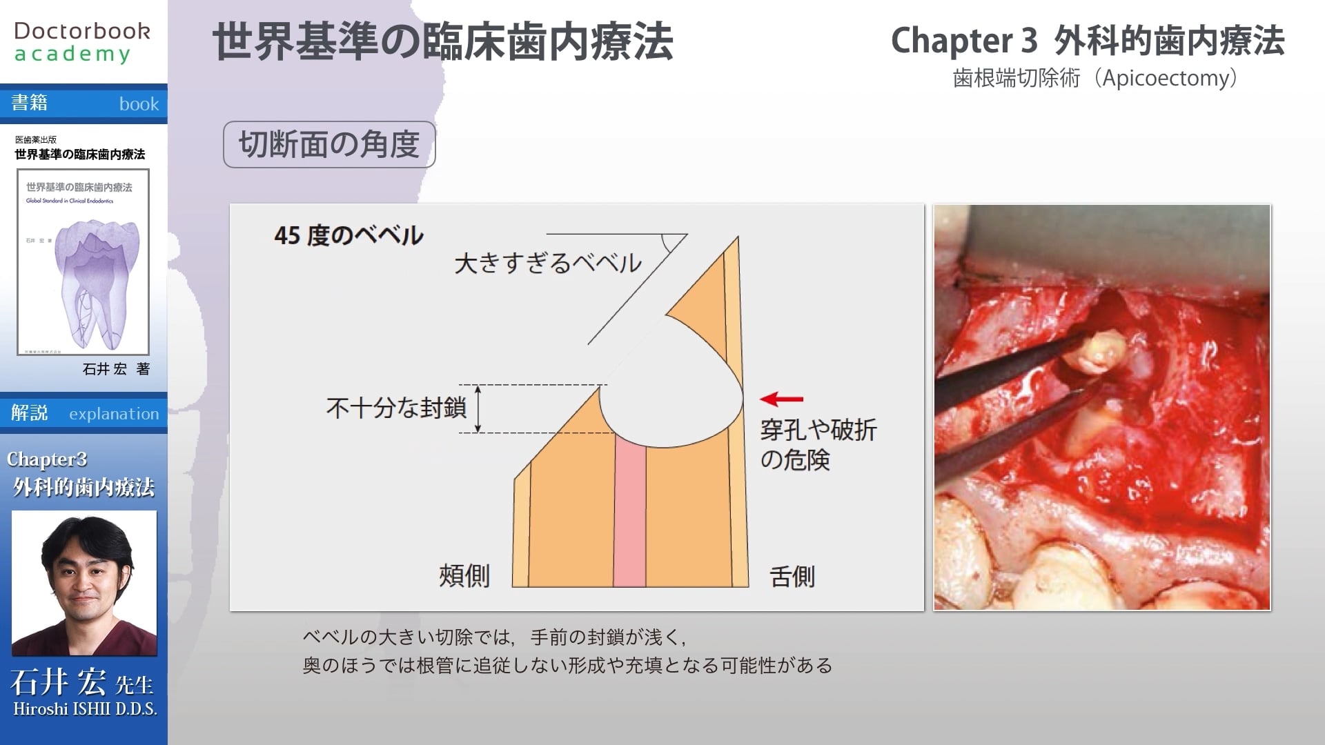 臨床知見録_歯根端切除_切断面の角度