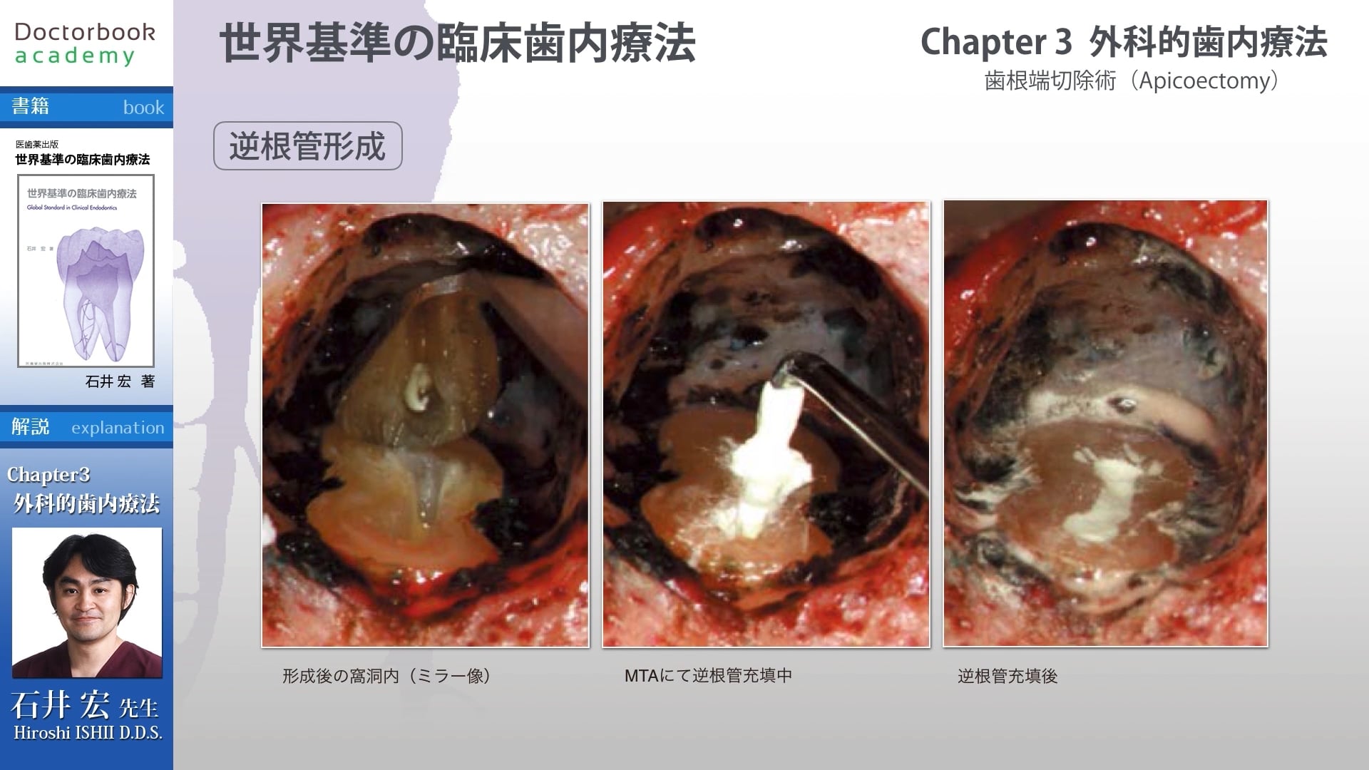 臨床知見録_歯根端切除_ナイロン糸の質