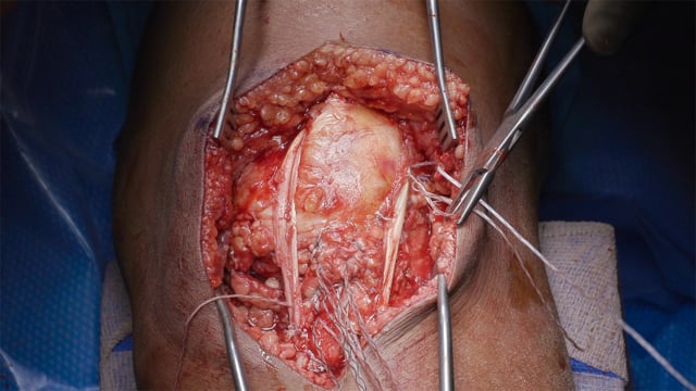 Repair of Midsubstance Patellar Tendon Rupture with Hamstring Autograft  Augmentation - NYU Langone Orthopedic Digital Library