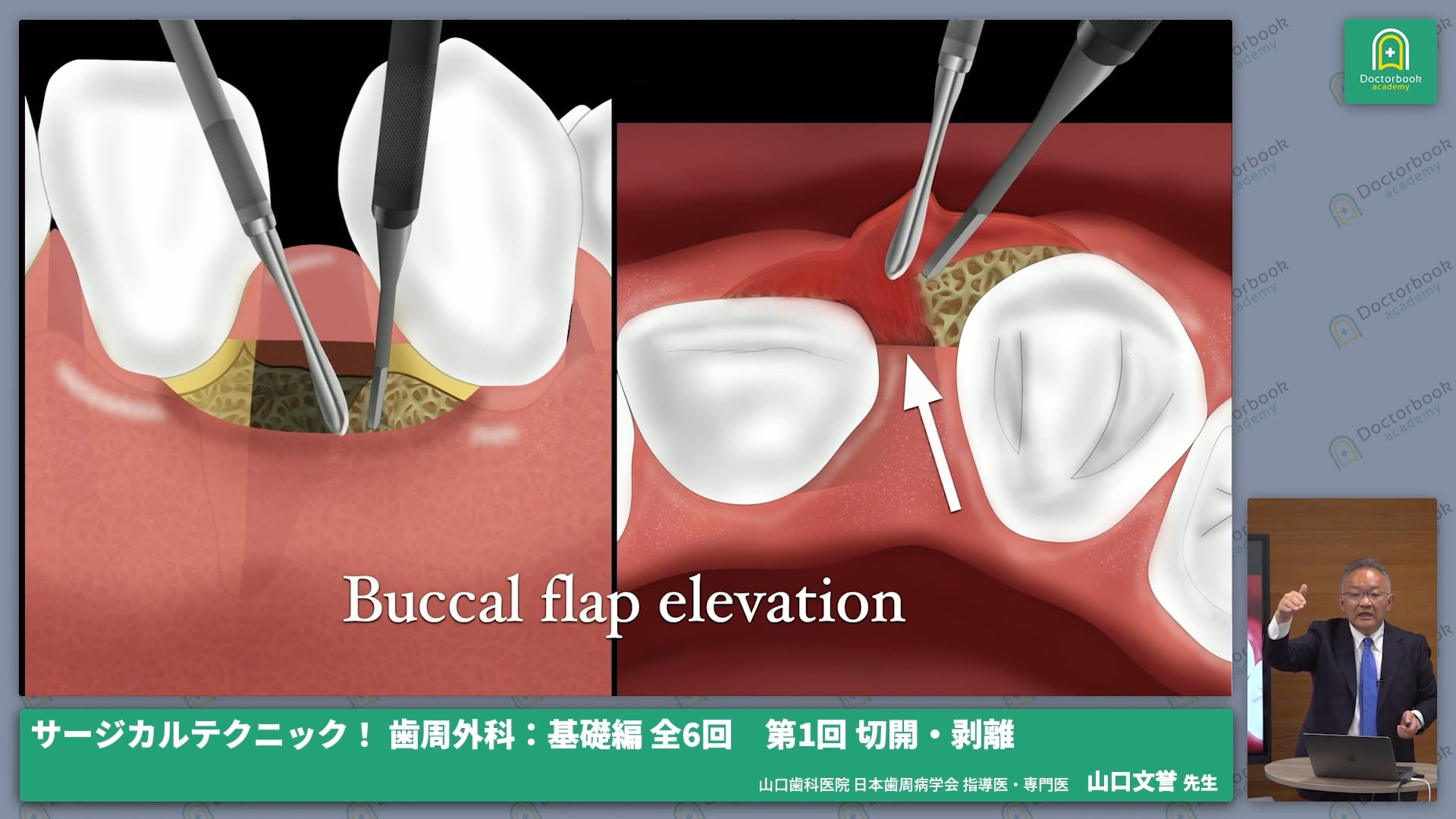 臨床知見録_切開・剥離・縫合_メスと剥離子を用いてフラップ展開する方法