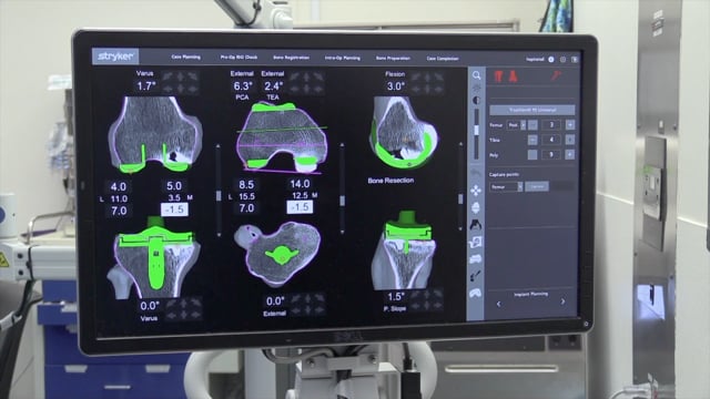 Robotic Arm Assisted Conversion of a Medial UKA to Total Knee Arthroplasty