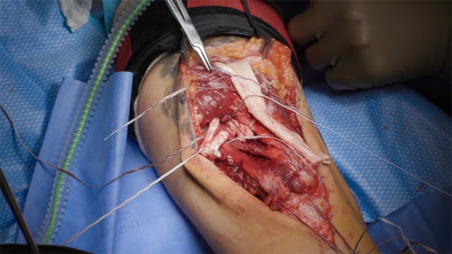 Distal Triceps Tendon Reconstruction with Achilles Allograft