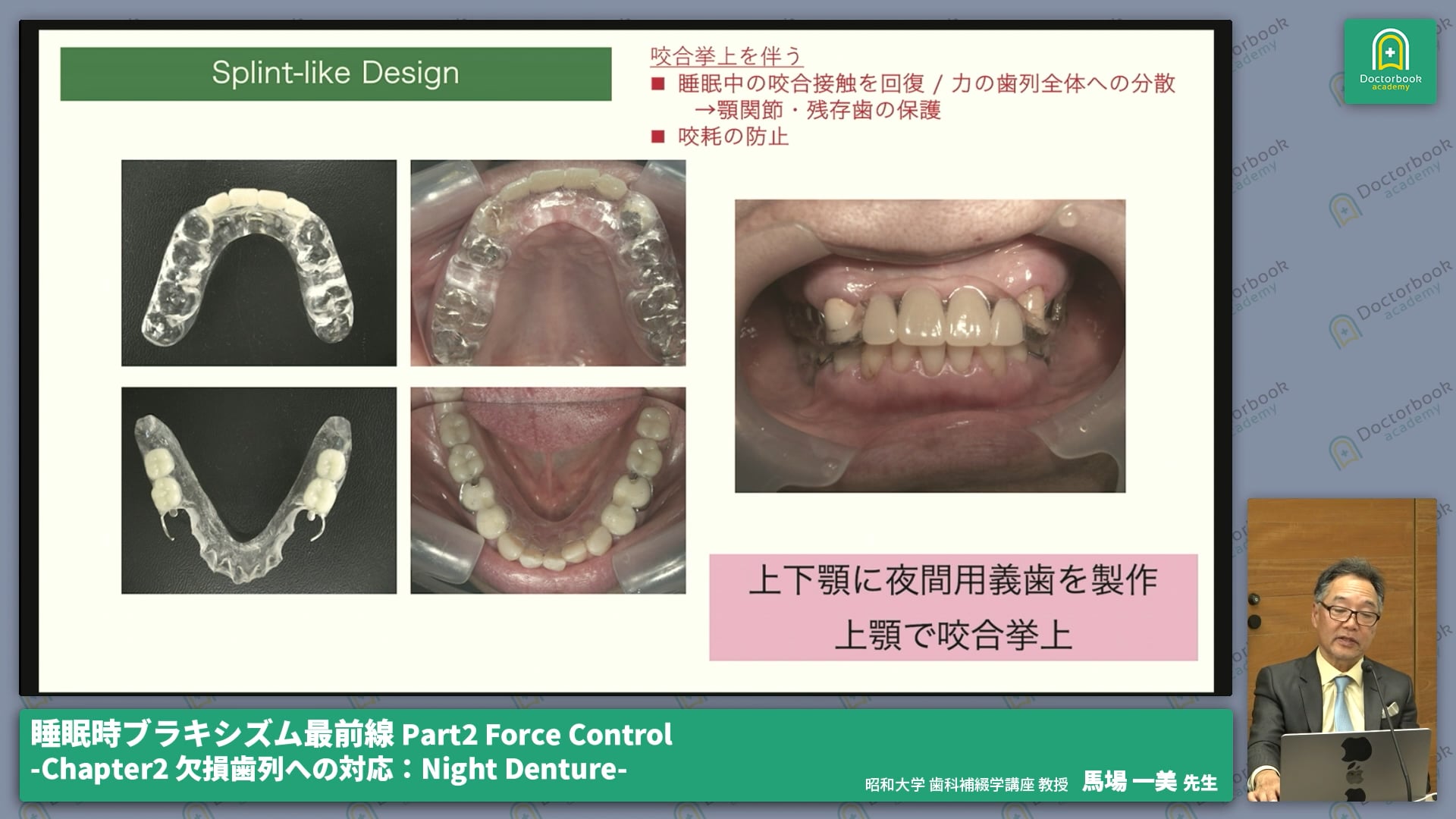 Part2 Force Control-Chapter2 欠損歯列への対応：Night Denture-