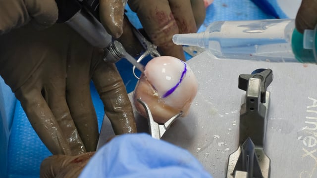 Humeral Head Allograft Reconstruction and Glenoid Reconstruction with Distal Tibial Allograft