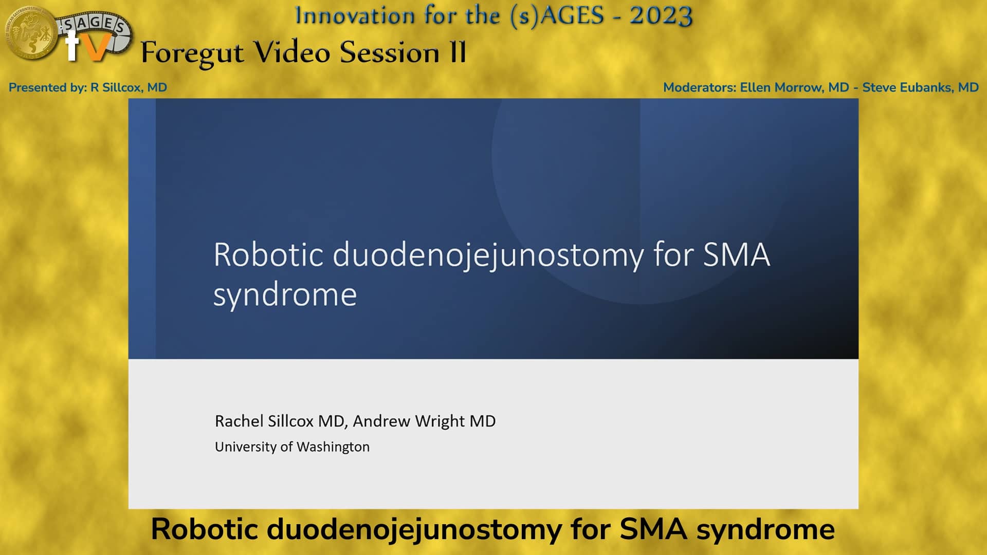 Robotic duodenojejunostomy for SMA syndrome on Vimeo