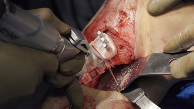 Biplanar HTO for Sagital Malalignment in Revision ACL Reconstruction