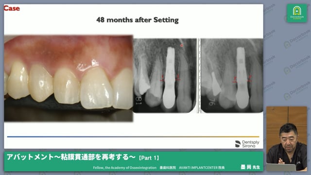 インプラントにおけるアバットメント～粘膜貫通部を再考する～ #1