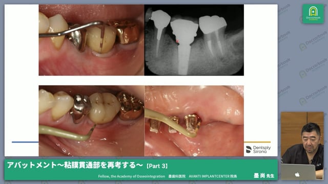 アバットメントはメタル・ジルコニアのどちらが有用？ #3