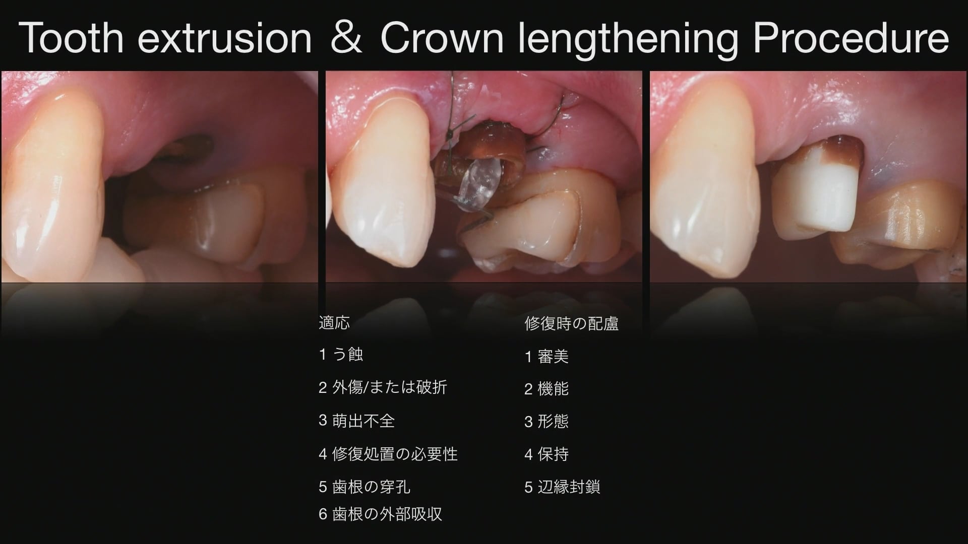臨床知見録_クラウンレングスニング_適応症と修復時の配慮