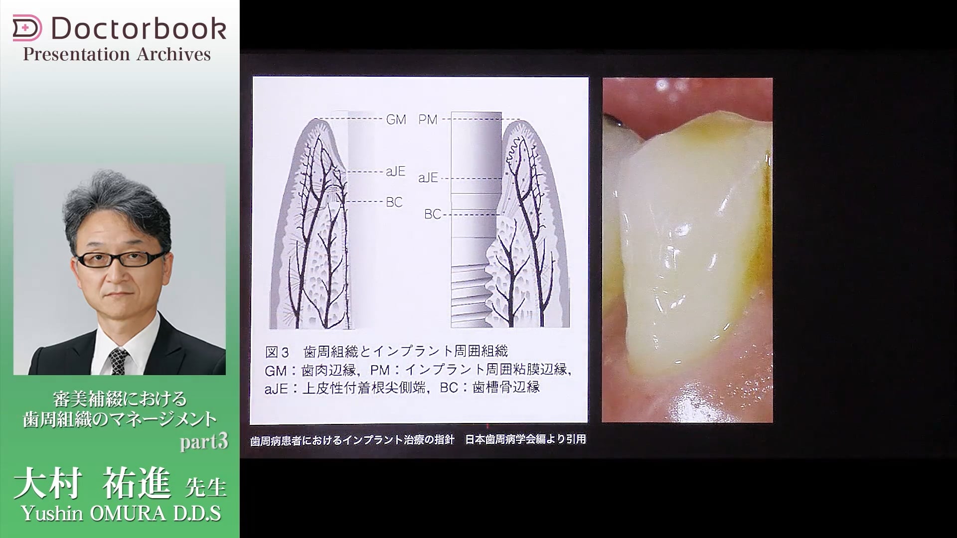 臨床知見録_クラウンレングスニング_インプラントの周囲の生物学的幅径