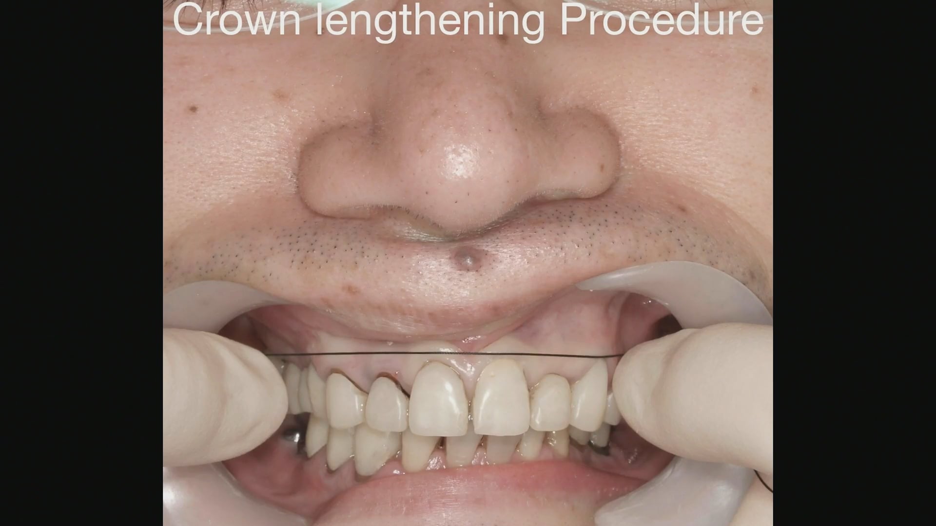 臨床知見録_クラウンレングスニング_Crown Lengthening Procedure