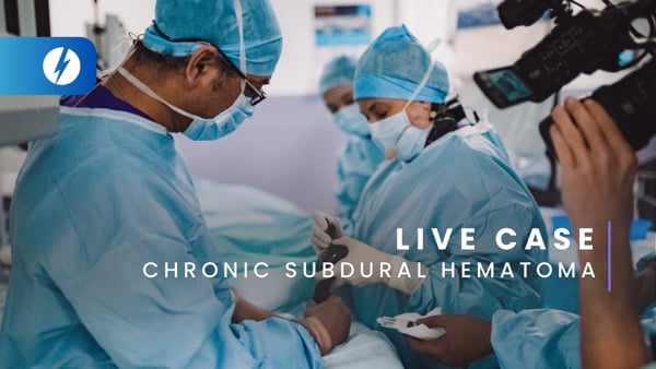 Chronic Subdural Hematoma