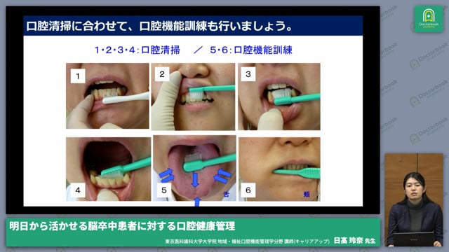 脳卒中患者の口腔内の特徴 | Doctorbook academy (ドクターブック