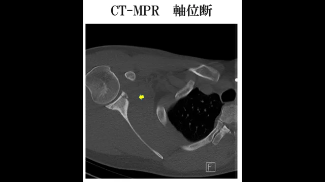 関節窩骨折　CT-MPR法　軸位断