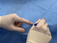 Live surgery tuesday tendon transfer