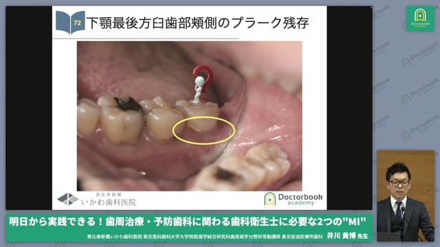 予防治療：口腔衛生指導 #4