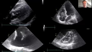 Preoperative focused cardiac ultrasound screening in non-cardiac surgery.