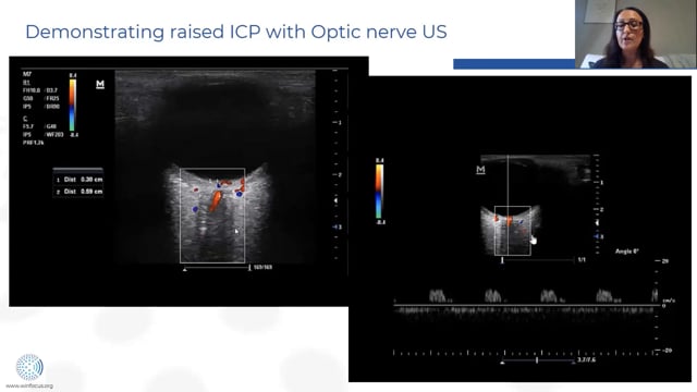 Ultrasound for the evaluation of intracranial pressure