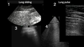 Pneumothorax detection with lung ultrasound in cardiac arrest. What is the evidence?