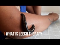 2. What is Leech therapy