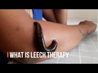 2. What is Leech therapy