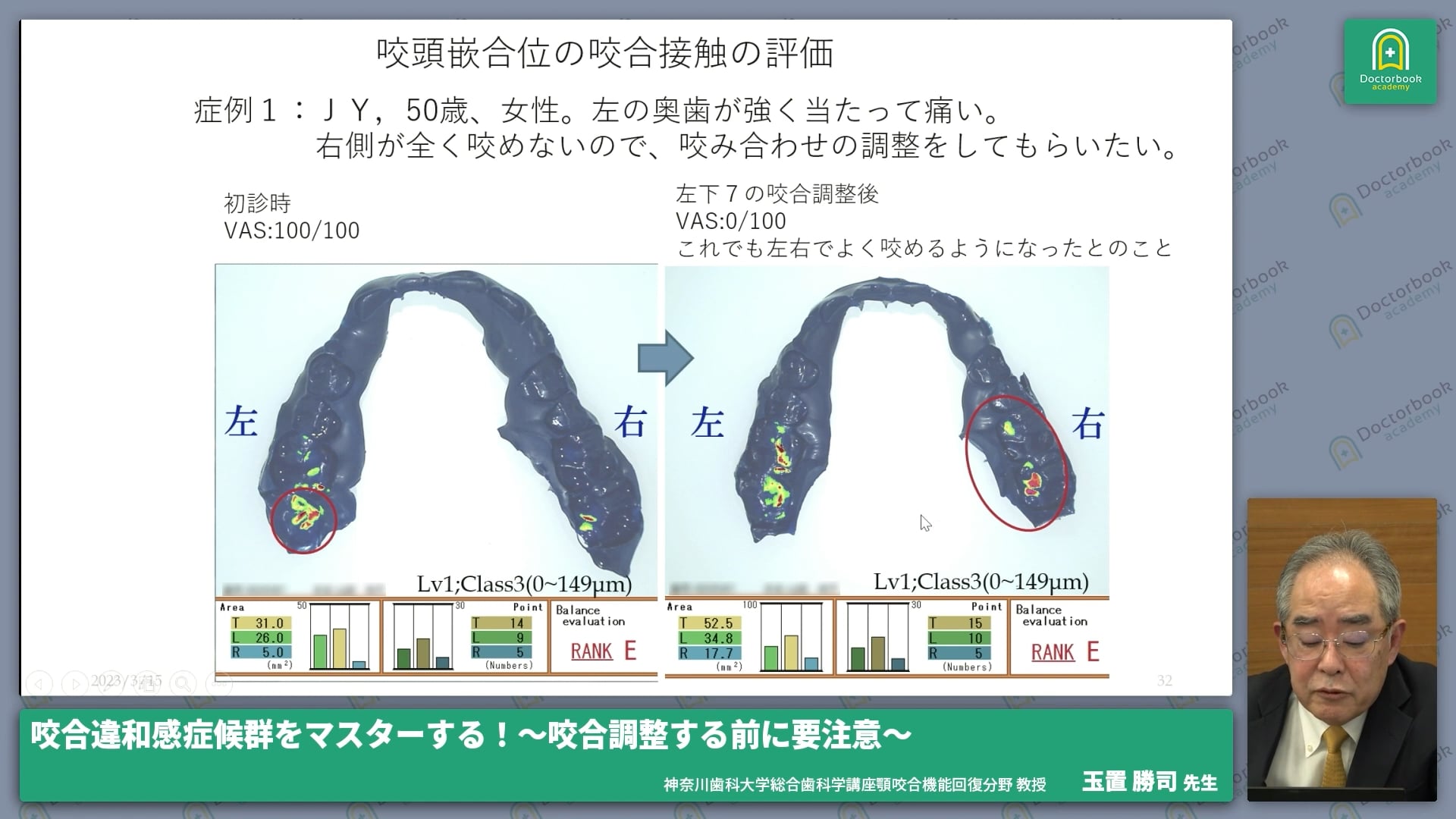 【前編】咬合違和感症候群（ODS:Occlusal discomfort syndrome）とは？ #2