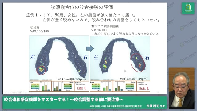 【前編】咬合違和感症候群（ODS:Occlusal discomfort syndrome）とは？ #2