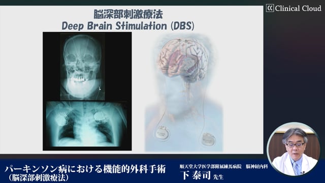 パーキンソン病における機能的外科手術（脳深部刺激療法） -Part1-