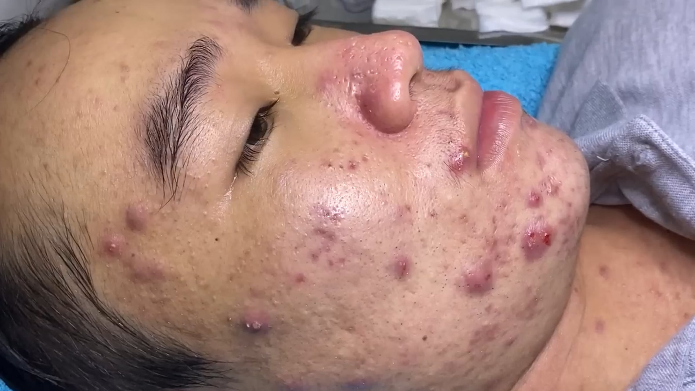 Big Cystic Acne Blackheads Extraction Blackheads & Milia, Whiteheads ...