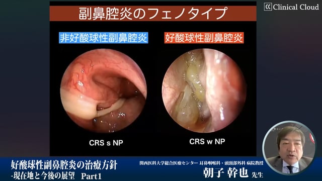 好酸球性副鼻腔炎の治療方針　-現在地と今後の展望-　Part1