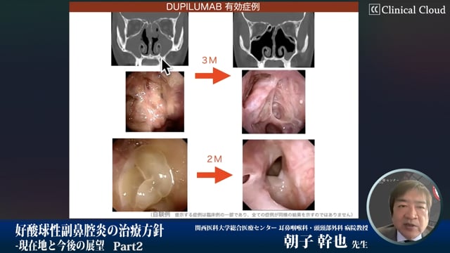 好酸球性副鼻腔炎の治療方針　-現在地と今後の展望-　Part2