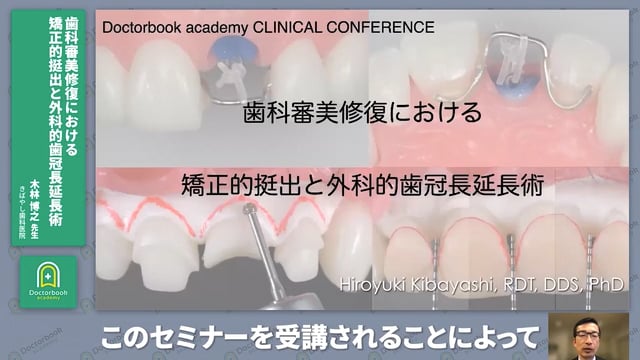 Introduction│歯科審美修復における矯正的挺出(MTM)と歯冠長延長術