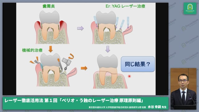 レーザー徹底活用法について│１回「ペリオ・う蝕のレーザー治療 原理原則編」  #1