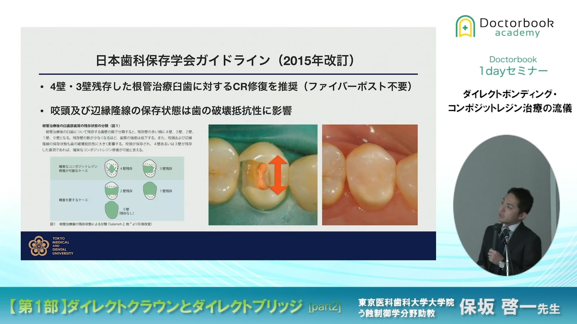 臨床知見録_ダイレクトボンディング_ガイドラインでCR修復を推奨する場合