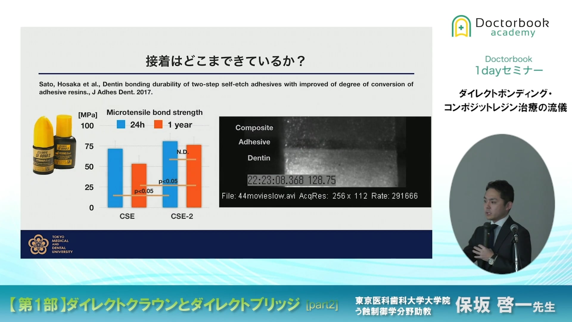 臨床知見録_ダイレクトボンディング_クリアフィルメガボンドの紹介