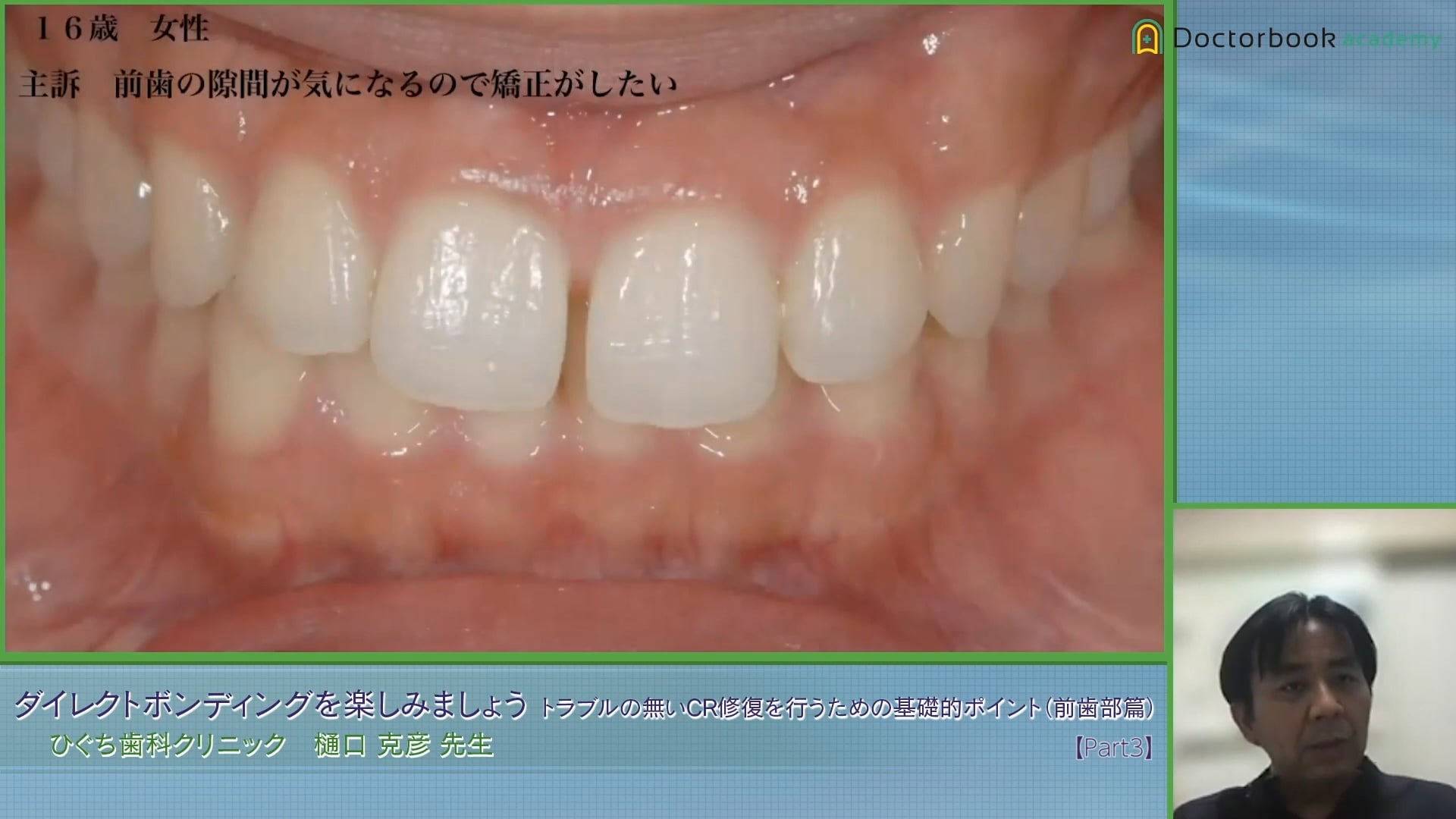 臨床知見録_ダイレクトボンディング_前歯部の隙間をCRで充填した症例