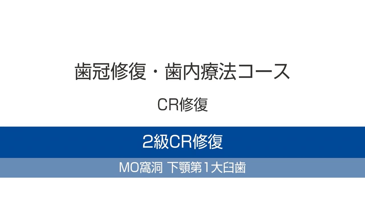 臨床知見録_ダイレクトボンディング_下顎第一大臼歯におけるMO窩洞のCR修復