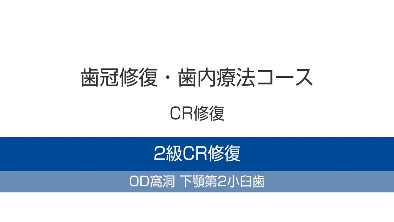 臨床知見録_ダイレクトボンディング_下顎第二小臼歯におけるOD窩洞のCR修復