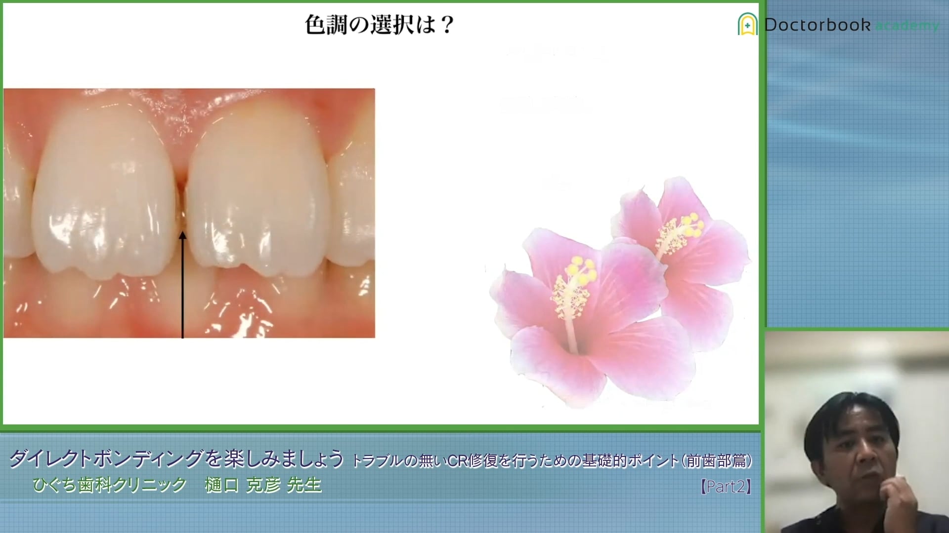 臨床知見録_ダイレクトボンディング_レジンの色調選択について