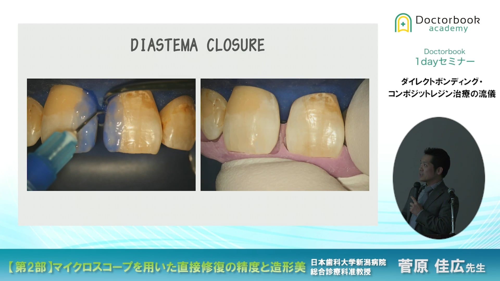 臨床知見録_ダイレクトボンディング_DIASTEMA CLOSURE