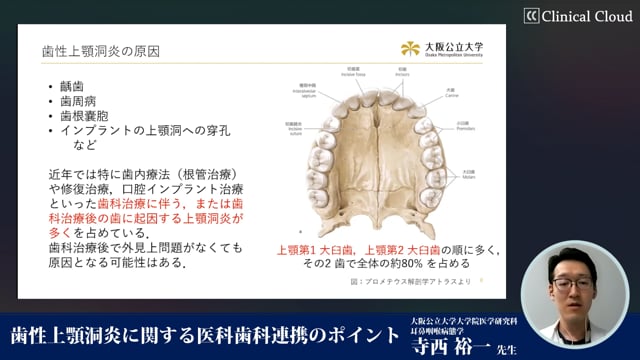 歯性上顎洞炎に関する医科歯科連携のポイント #1