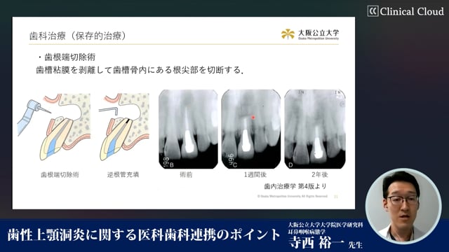 歯性上顎洞炎に関する医科歯科連携のポイント　Part2