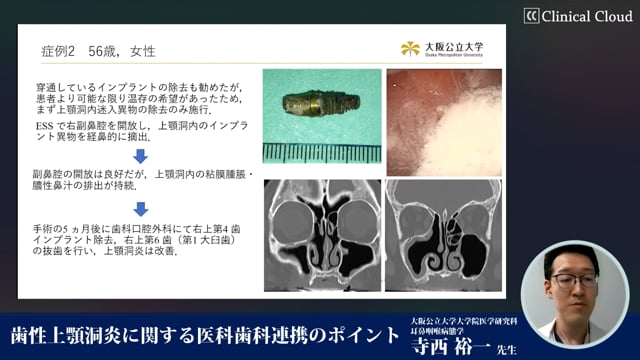 歯性上顎洞炎に関する医科歯科連携のポイント #3