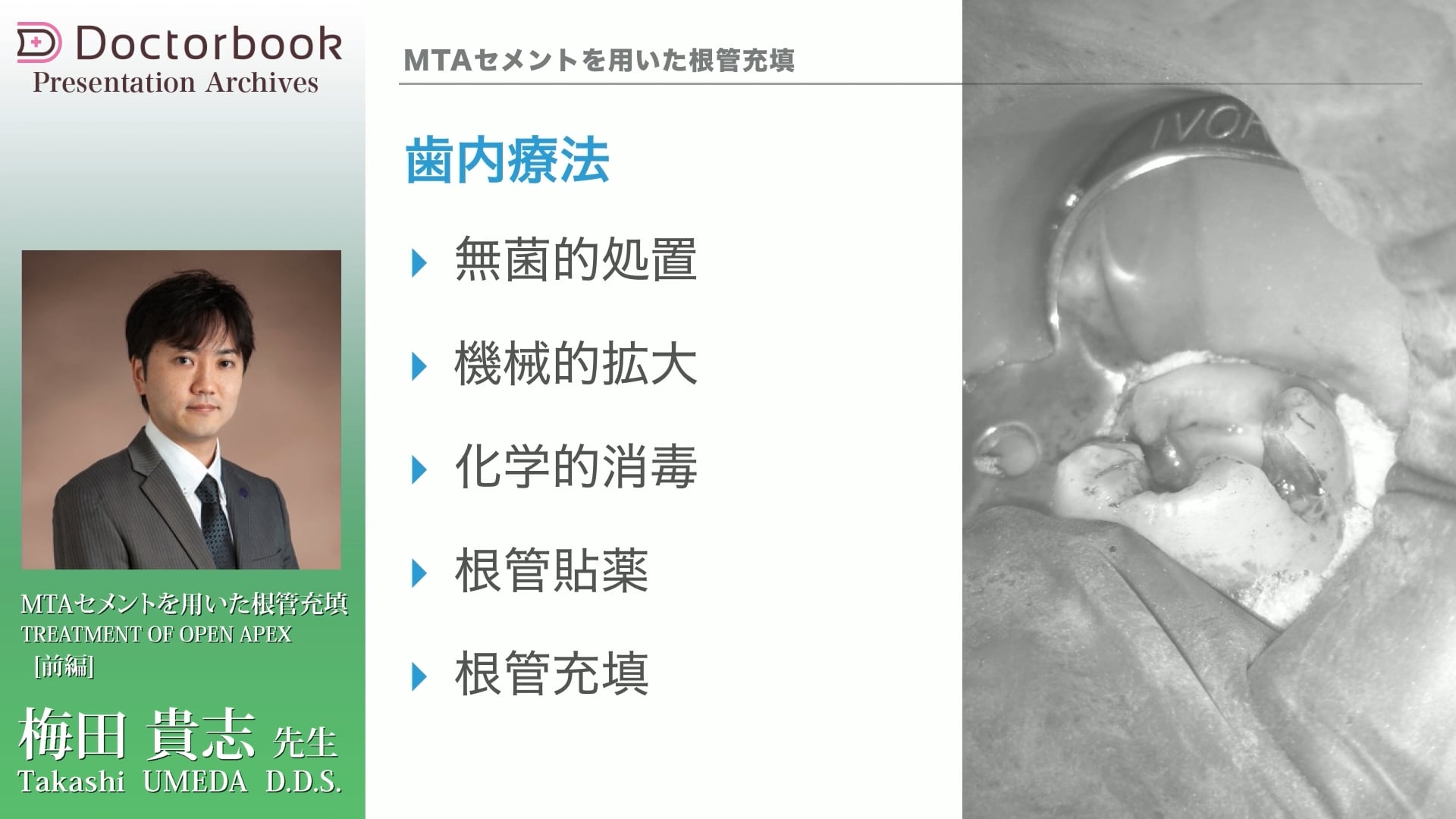 臨床知見録_根管充塡_根管治療全体の目的